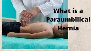 What is a Paraumbilical Hernia [upl. by Stringer]