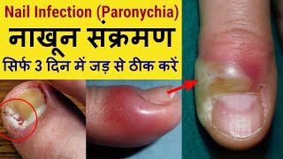 Nail Infection Paronychia  Cause amp Treatment  नाखून संक्रमण का इलाज कैसे करें [upl. by Nniroc]