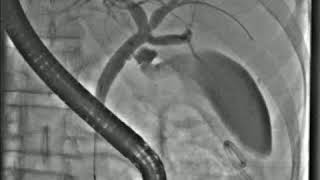 ERCP for bile leak from liver trauma [upl. by Ellersick]