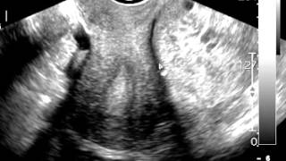 Ovarian Torsion Ultrasound Discussed by Radiologist [upl. by Cilurzo470]