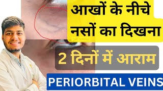 आँखों के नीचे गहरे हरे रंग की नसें दिखाई देने का क्या कारण है ॥ PERIORBITAL VEINS UNDER EYES [upl. by Halivah]