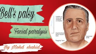 Bells palsy ll Facial palsy ll Facial paralysis [upl. by Yellac]