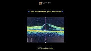 Pseudophakic cystoid macular edema [upl. by Boony]