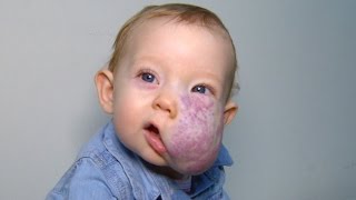 See 2YearOlds Incredible Transformation After Surgery To Remove Facial Tumor [upl. by Leesa956]