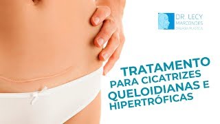 Como tratar e melhorar o aspecto das cicatrizes Queloides e Hipertróficas Cirurgião Dr Lecy explica [upl. by Kimmie]