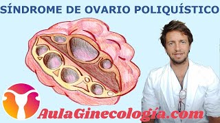 SÍNDROME de OVARIO POLIQUÍSTICO causas síntomas y diagnóstico  Ginecología y Obstetricia [upl. by Imim]