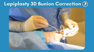 Lapiplasty Procedure  3D Bunion Correction with Dr Paul Steinke [upl. by Amalita955]