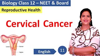 Cervical Cancer  Reproductive Health [upl. by Anawahs]