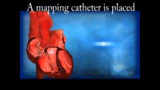 Ventricular Tachycardia VT Ablation [upl. by Lletnohs853]