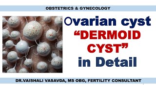 DERMOID CYSTS IN THE OVARY  DRVAISHALI VASAVDA [upl. by Airb]