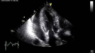 TAMPONADE LEFT VENTRICULAR DIASTOLIC COLLAPSE [upl. by Airamahs]