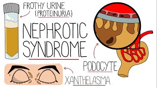 Nephrotic Syndrome Explained Clearly [upl. by Catha]