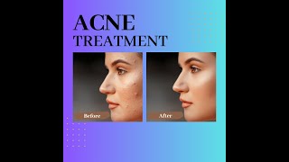 Acnevit serum How to use acne best creamskin health care [upl. by Yelsha]