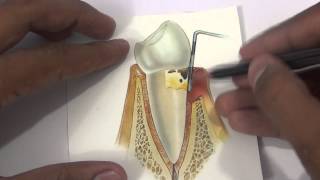 Stages of Gum  Gingival Inflammation  Gingivitis and Periodontitis Stages [upl. by Voltz885]