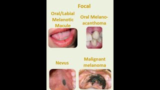 8 Focal melanosis [upl. by Ivar]