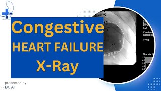 Congestive Heart Failure Chest X Ray CHF Radiology [upl. by Llenrup]