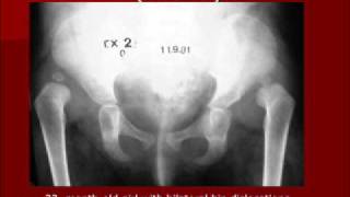 developmental dysplasia of the hip the modified hoffmann daimler methodwmv [upl. by Yenial]