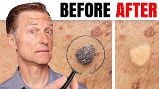 How to Remove Skin Tags and Warts Overnight  Dr Berg Explains [upl. by Evander205]