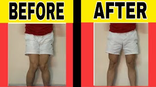 Knock Knees correction without Surgery  HOW TO FIX PROBLEM OF KNOCK KNEE  Knock Knees Treatment [upl. by Aiet]