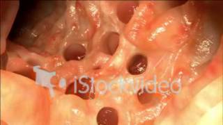 PyroEnergen  Colonic Diverticulum or Diverticulitis Large Intestine Holes  How it Looks Like [upl. by Marve]