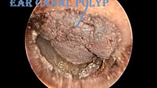 Otoendoscopic Dried Hemorrhagic Ear Canal Polyp Removal [upl. by Lletram614]