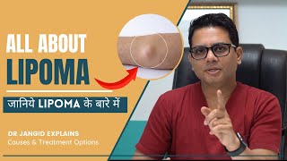 All About Lipoma  What are the causes and treatment options for Lipma  Lipoma Surgery in Delhi [upl. by Damha321]