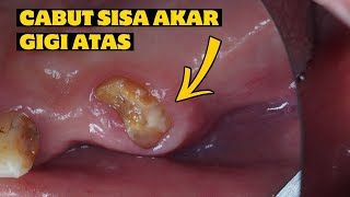 CABUT GIGI  SISA AKAR GIGI  PENCABUTAN GIGI ATAS  Dentist  Dokter Gigi Tri Putra [upl. by Clary]