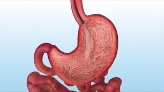 intra gastric balloon insertion in delhi best balloon treatment non surgical weight loss [upl. by Elleoj]