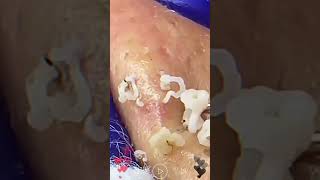 Skincare  Blackheads Removal 017 blackheads blackheads skincare [upl. by Oht835]