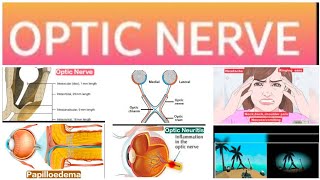 Optic Nerve 2Major Papilloedema 1 [upl. by Garin82]