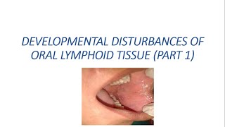 Developmental disturbances of oral lymphoid tissue PART 1 [upl. by Rotman569]