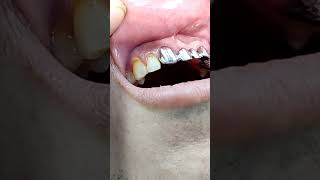 Dental bridge PFM at clinic [upl. by Helbonna]