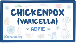 Chickenpox Varicella Nursing Process ADPIE [upl. by Drhcir]