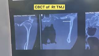 TMJ Arthrocentesis [upl. by Mead]