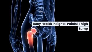 Painful Thigh Lump Common Causes and When to Seek Medical Care  BuoyHealthcom [upl. by Nelg]