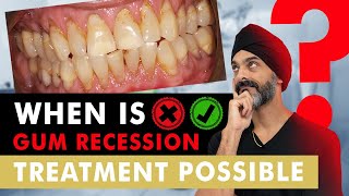 Gum Recession  Is there a cure [upl. by Chappie]