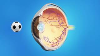 YAG Capsulotomy After Cataract Surgery [upl. by Hatcher]