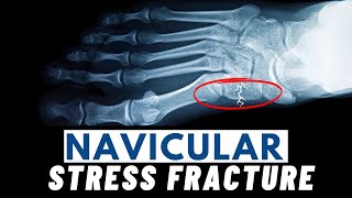 Navicular Stress Fractures  Symptoms Causes Diagnosis amp Treatment [upl. by Gettings]