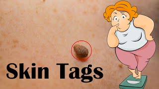 Skin Tags Acrochordon  Causes Signs amp Symptoms And Treatment [upl. by Atinaw]