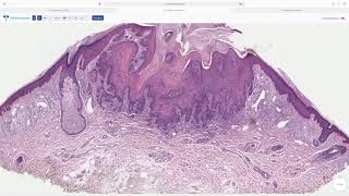 Dermatopathology Keratoacanthoma [upl. by Enelyak]