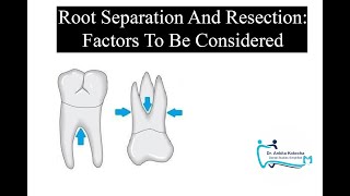 ROOT SEPARATION AND RESECTION Factors to be considered treatment of furcation involvement [upl. by Akimrehs570]