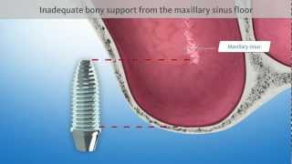 Sinus floor elevation Dental Animation [upl. by Ohce]