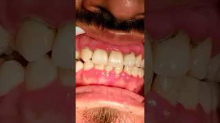 Scaling amp Polishing 😳😱🫢 dentistaentiktok dentist dentistteeth teethwhiteningprocedure [upl. by Yroger]