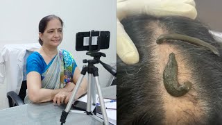 leech therapy by Dr Manjusha khurana Sanjivani Health Care karnal [upl. by Lichter278]