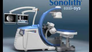 New generation extracorporeal shock wave lithotripsy system for kidney stone treatment [upl. by Sheilah]