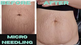 I Got Professional Microneedling Done on my Stretch Marks Results and What to Expect [upl. by Mariette624]