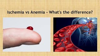 Ischemia vs Anaemia Simple way to learn [upl. by Ethelyn]