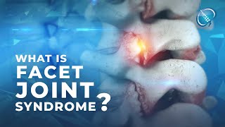 What is Facet Joint Syndrome [upl. by Gurolinick]