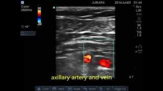 PEC1PEC2 block T2ampT3 intercostal nerve block [upl. by Yhtur]