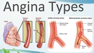 Angina pectoris types [upl. by Changaris]